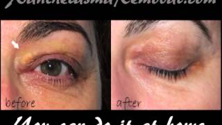 Xanthelasma removal at home [upl. by Finer]