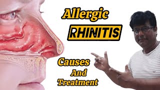 Allergic Rhinitis Causes and Treatment [upl. by Inuat]