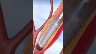 Angioplasty procedure animation shortsheartattackcardiac surgerystentbypass [upl. by Llerreg276]