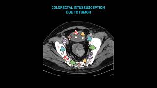 17⏰️COLORECTAL INTUSSUSCEPTION DUE TO TUMOR 👉Coronal and axial CT images🌺 [upl. by Akiehsat927]