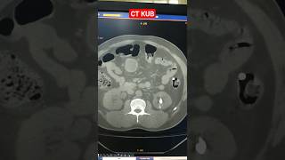 CT KUB shorts radiology [upl. by Abba241]