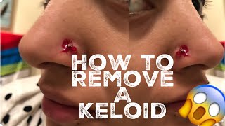 How I Removed My Nose Piercing Bump keloid [upl. by Akimert]