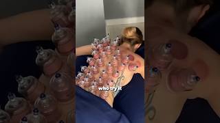 Cupping Therapy Explanation [upl. by Nyleikcaj883]