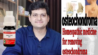 Homeopathic medicine for removing osteochondroma  explain  bone tumor [upl. by Frederica303]