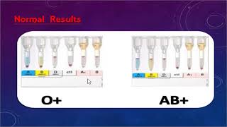 ABO discrepancy and transfusion practice part one By Dr Mohamed Samir [upl. by Louella]