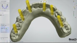 Fabrication of the BruxZir® FullArch Implant Prosthesis Vol 1 Issue 2 [upl. by Clement516]