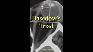 Basedows Triad Merseburger Triad GravesBasedow disease [upl. by Sivolc]