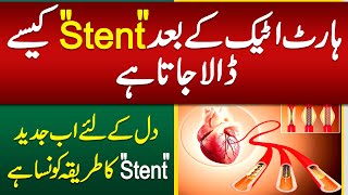 Heart Stent Procedure  Heart Stent Kaise Dalte Hain  Heart Attack Stent Procedure [upl. by Ariom]