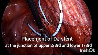 LAPAROSCOPIC URETEROLITHOTOMY FOR LOWER URETERIC STONE [upl. by Inez]