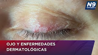 OJO Y ENFERMEDADES DERMATOLÓGICAS  NOTICIERO 9 [upl. by Giovanna921]