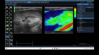 IQ 329 KIDNEY ULTRASOUND ELASTOGRAPHY ECHOPAC ANALYSIS CRF [upl. by Valera]