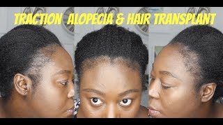 Battling Traction Alopecia and Getting Hair Transplant [upl. by Taimi]