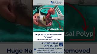 Huge Nasal Polyp Removed Tansorally Endoscopic AC Polyp Removal ent [upl. by Pris680]