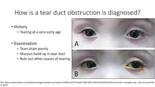 AAPOS Nasolacrimal Duct Obstruction [upl. by Atauqal]