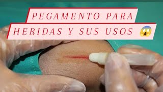 Cianocrilato para pegar heridas y sus usos médicos odontología medicina heridas sutura fypシ [upl. by Nivrek]