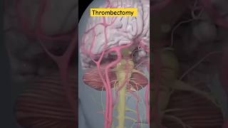 mechanical thrombectomy strokeanatomymedicalcareofHow [upl. by Uy906]