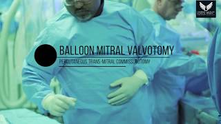 Balloon Mitral Valvotomy [upl. by Rehpotsirhc977]