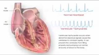 Apa Itu Ventrikel Fibrilasi Ventrikel Takikardi Atrial Fibrilasi Atrial Takikardi  SVT [upl. by Horwath56]