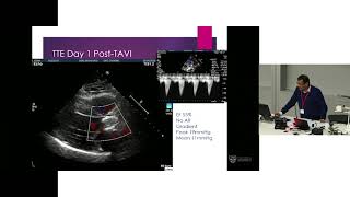 TAVI for Bicuspid Aortic Valves  Dr Rohan Bhagwandeen [upl. by Valera]