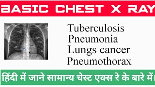 Interpret chest x ray  Basic chest X Rayसामान्य चेस्ट एक्स रे Hindi में आसानी से समझेTb chest [upl. by Deste]