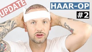 Der Tag nach der OP  Meine 2 Haartransplantation Geheimratsecken – Grey Young [upl. by Hardunn]