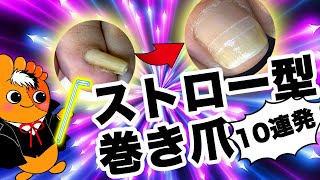 爽快！巻き爪矯正改善集〜ストロー型重度巻き爪編〜【教えて！巻き爪先生】Vol3 by Pincer Nails Treatmemt Center®︎ [upl. by Driskill983]