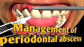 Management of periodontal abscess  Treatment of periodontal abscess  treatment of lateral abscess [upl. by Manya]