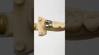 Full Cast Gold Molar ​⁠EnvisiontecMain envisiontec lsk121shorts dentist [upl. by Nanfa]