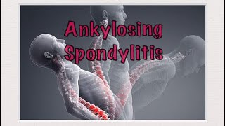 Ankylosing Spondylitis HLAB27  Rheumatology  MisMedicine [upl. by Sunderland]