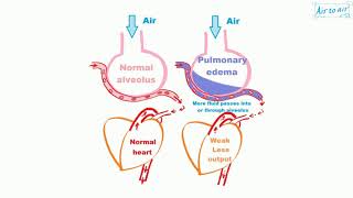 pulmonary edema [upl. by Legnaros]