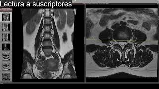 Interpretando una resonancia lumbar  Dolor lumbar [upl. by Ellinej536]