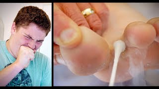 OUCH FREEZING BIG WARTS BETWEEN TOES with liquid nitrogen  Dr Paul [upl. by Lletnahc768]