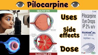 pilocarpine eye drops  pilocar 2 eye drops  pilocarpine eye drops ip 2 wv in hindi [upl. by Davidson]