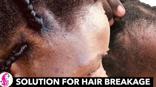 How To Stop Your Front Hair Line From Breaking While Plaiting Braids [upl. by Arbua]