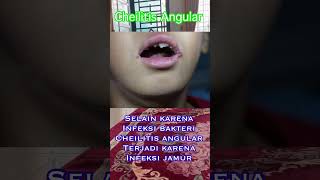 Penyebab cheilitis angular sariawan shorts penyakit bibirkering fyp [upl. by Docilla]