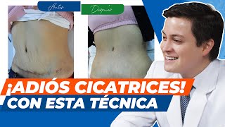 Cómo quitar las cicatrices postquirúrgicas  Medicina estética en Perú [upl. by Kerat]