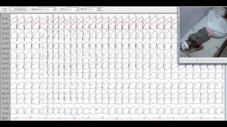 Epilepsy with myoclonic absences 2 of 2 [upl. by Ledarf]