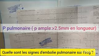 QUELLE SONT LES SIGNES DEMBOLIE PULMONAIRE SUR LECG CAS PRATIQUE [upl. by Chrisse]