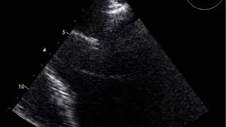 Transesophageal echocardiography TOEendocarditis of mitral valve with a small vegetation [upl. by Hiltner]