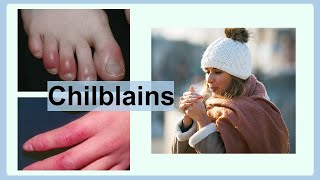 chilblains [upl. by Benton718]