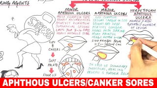 Aphthous Ulcers  Canker Sores  Pathophysiology Triggers Types amp Treatment [upl. by Novyaj593]