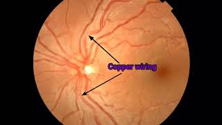 Hypertensive Retinopathy on Ophthalmoscope Cardiology  Medicine [upl. by Anni]