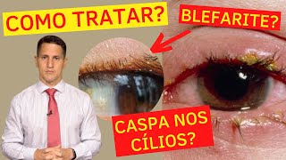 COMO ACABAR COM A CASPA NOS CÍLIOS  TRATAMENTO DA BLEFARITE  Dr Arthur Farache [upl. by Anglim310]