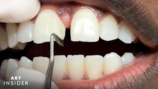 How Tooth Gaps Are Filled  Insider Art [upl. by Anilos]