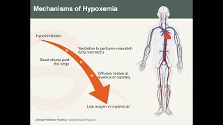 Hypoxemia amp Hypoxia [upl. by Yolande32]