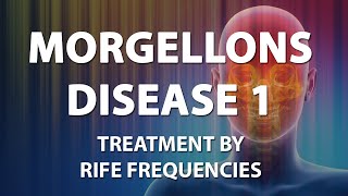 Morgellons Disease 1  RIFE Frequencies Treatment  Energy amp Quantum Medicine with Bioresonance [upl. by Hsekar]