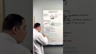 Ischemic Stroke  Lacunar Infarct shorts [upl. by Allista]