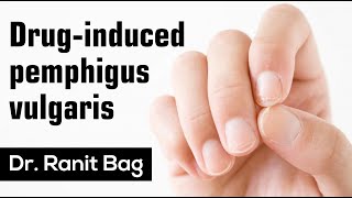 Druginduced pemphigus vulgaris in Mouth  Medical Conference  Treatment  Dr Ranit Bag [upl. by Llednyl]