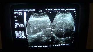 PREGNANCY with FIBROIDS [upl. by Inoue262]