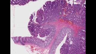 Histopathology Colon Tubular adenoma adenomatous polyp [upl. by Marilee]